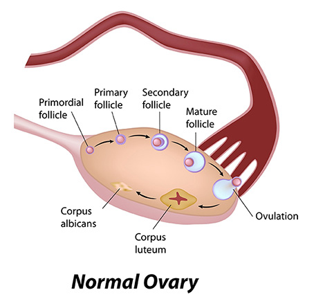 What is PCOS