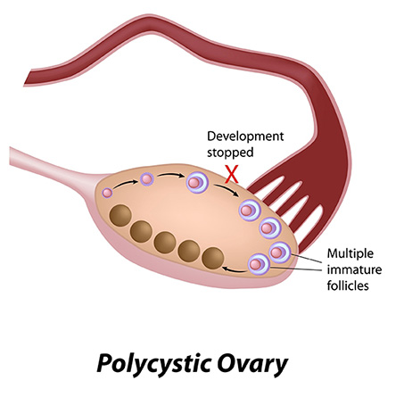 What is PCOS, 1