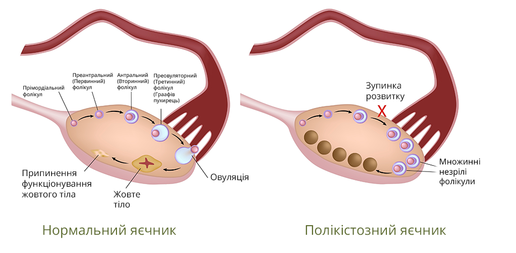 гиперстимуляция яичников после пункции